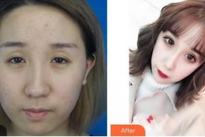 昆明阿瑪施眼科門診部王立東整形價格表附切開雙眼皮案例展示