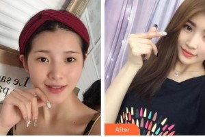 昆明拜博口腔醫(yī)院梁娜整形價格表附切開雙眼皮案例展示