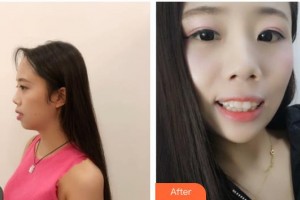 昆明拜博口腔醫(yī)院何繡君整形價格表附牙齒隱形矯正案例展示