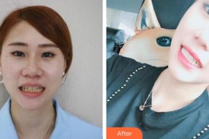 昆明拜博口腔醫(yī)院羅金燕整形價格表附美白劑美白牙齒案例展示