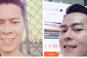 昆明拜博口腔醫(yī)院謝岳英整形價格表附金屬托槽矯正案例展示