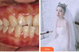 昆明拜博口腔醫(yī)院張琳整形價格表附牙齒隱形矯正案例展示