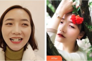 昆明拜博口腔醫(yī)院湯惟惟整形價(jià)格表附牙齒隱形矯正案例展示