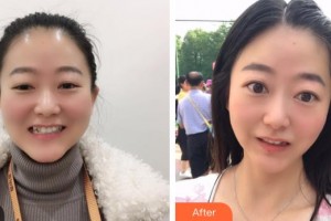 昆明拜博口腔醫(yī)院蒲濤整形價格表附美白劑美白牙齒案例展示