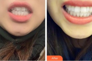 昆明美立方（原大華）醫(yī)療美容醫(yī)院亞明宏整形價格表附牙齒隱形矯正案例展示