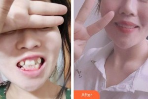 昆明赫柏醫(yī)療美容門診部都顥整形價(jià)格表附牙齒隱形矯正例展示