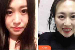 昆明先行口腔門診部秦泰整形價(jià)格表附冷光美白案例展示