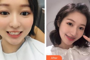 昆明尚愛韓美口腔門診部孫亞杰整形價(jià)格表附美白劑美白牙齒案例展示