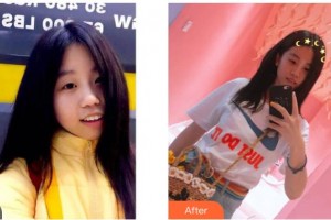 昆明醫(yī)科大學(xué)附屬口腔醫(yī)院億大口腔門診部莊承翰整形價(jià)格表附牙齒隱形矯正案例展示