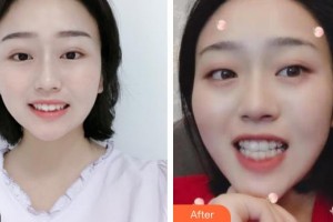 昆明赫柏醫(yī)療美容門診部呂杰整形價(jià)格表附牙齒隱形矯正案例展示