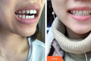 昆明尚愛韓美口腔門診部何偉整形價(jià)格表附金屬托槽矯正案例展示