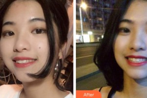 武漢葉子醫(yī)療美容醫(yī)院張孝珍整形價格表附牙齒矯正案例展示