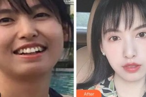 昆明尚愛韓美口腔門診部李滿坡整形價(jià)格表附牙齒隱形矯正案例展示