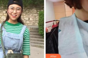 昆明拜博口腔醫(yī)院吳志航整形價格表附牙齒隱形矯正案例展示