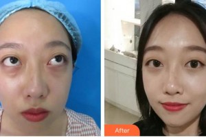 曲靖市第一人民醫(yī)院醫(yī)學(xué)整形美容科陳華林整形價(jià)格表附激光去眼袋案例展示