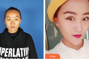 曲靖愛(ài)爾眼科醫(yī)院張光學(xué)整形價(jià)格表附眼部綜合案例展示