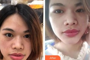 曲靖愛爾眼科醫(yī)院龔永祥整形價格表附激光去眼袋案例展示