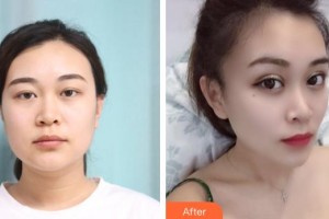 曲靖愛(ài)爾眼科醫(yī)院岳煜整形價(jià)格表附眼部綜合案例展示