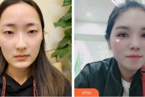 曲靖愛爾眼科醫(yī)院張慶云整形價格表附眼部綜合案例展示