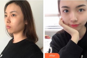 曲靖愛爾眼科醫(yī)院楊亦整形價格表附眼部綜合案例展示