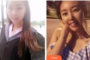 曲靖口腔醫(yī)院張華鳳整形價格表附牙齒陶瓷矯正案例展示