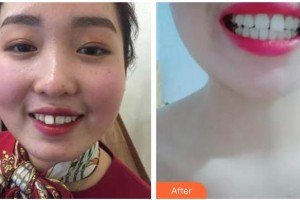 曲靖卓美口腔門診部梁沙整形價格表附牙齒隱形矯正案例展示