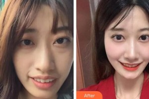 曲靖口腔醫(yī)院閻川整形價格表附牙齒陶瓷矯正案例展示