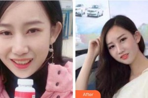 曲靖卓美口腔門診部張小米整形價格表附牙齒隱形矯正案例展示