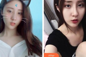 玉溪市人民醫(yī)院皮膚醫(yī)學(xué)美容外科矣平整形價格表附激光祛斑案例展示