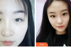 玉溪愛爾眼科醫(yī)院劉莎利整形價(jià)格表附眼部綜合案例展示