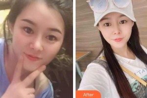 玉溪愛爾眼科醫(yī)院林泉整形價(jià)格表附內(nèi)切祛眼袋案例展示