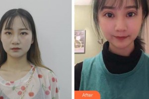 玉溪愛爾眼科醫(yī)院胡亞麗整形價格表附眼部綜合案例展示