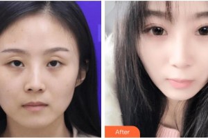 玉溪愛爾眼科醫(yī)院劉超整形價(jià)格表附眼部修復(fù)案例展示