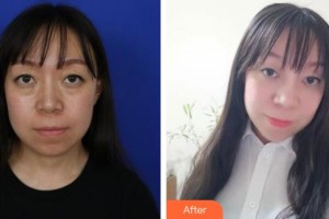 玉溪華山眼科醫(yī)院馬吉維整形價(jià)格表附外切祛眼袋案例展示