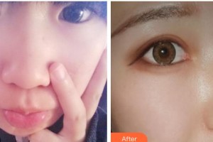 玉溪華山眼科醫(yī)院楊躍整形價(jià)格表附切開雙眼皮案例展示