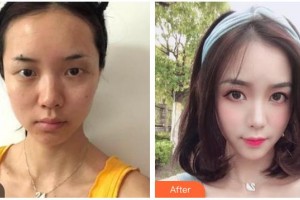 玉溪曹汝智醫(yī)療美容診所曹汝智整形價(jià)格表附眼部綜合案例展示