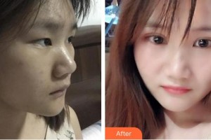 昭通愛麗諾醫(yī)療美容門診部祝向東整形價格表附開內(nèi)眼角案例展示