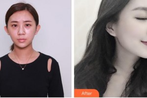 昭通瑪麗婦產(chǎn)醫(yī)院整形美容科曺秀沇整形價(jià)格表附膨體隆鼻案例展示