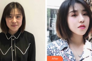 武漢美萊整形醫(yī)療美容醫(yī)院章晾整形價格表附皮膚美容案例展示