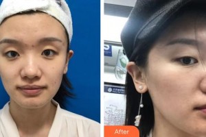 江蘇省蘇北人民醫(yī)院整形美容中心施澤宏整形價(jià)格表附去痘印痘坑案例展示