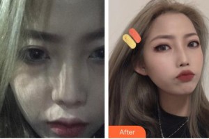 江蘇省人民醫(yī)院整形燒傷科史京萍整形價(jià)格表附清潔祛痘案例展示