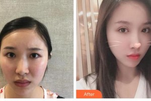 江蘇省第二中醫(yī)院眼科歐陽(yáng)永斌整形價(jià)格表附眼部綜合案例展示