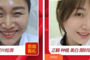 江蘇省口腔醫(yī)院倪杰整形價(jià)格表附冷光美白案例展示
