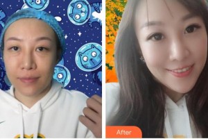 河北醫(yī)科大學第一醫(yī)院燒傷整形外科齊順貞整形價格表附激光去眼袋案例展示