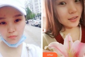 河北醫(yī)科大學第二醫(yī)院整形美容科張錘整形價格表附開內眼角案例展示