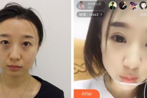 河北工程大學附屬醫(yī)院整形美容科謝玉娥整形價格表附切開雙眼皮案例展示