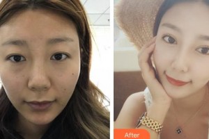 河北省中醫(yī)院醫(yī)療美容科羅磊整形價格表附眼部綜合案例展示