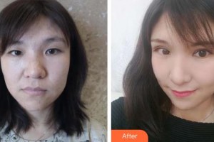 河北現(xiàn)代女子醫(yī)院整形美容中心曾慶明整形價格表附眼部綜合案例展示