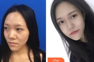 河北省中醫(yī)院醫(yī)療美容科四國軍整形價格表附鼻部綜合案例展示