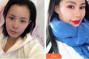 河北現(xiàn)代女子醫(yī)院整形美容中心易曉萍整形價格表附鼻部綜合案例展示